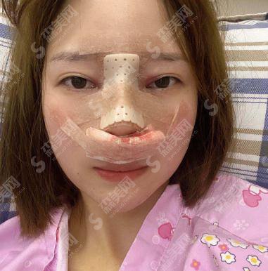 复旦大学附属中山医院青浦分院整形科价目表2020,内含肋软骨隆鼻具体方案果图