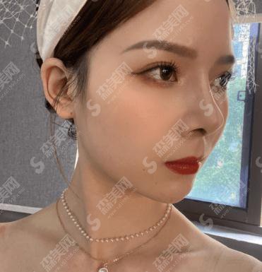 复旦大学附属中山医院青浦分院整形科价目表2020,内含肋软骨隆鼻具体方案果图