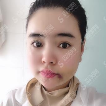 上海首尔丽格价目表2020/磨骨价格怎么样/内附崔荣达医生的磨骨果图