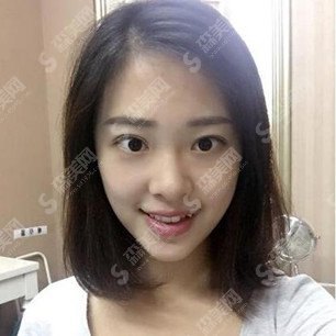 山东省立医院整形价目表2020/玻尿酸隆鼻的价格怎么样/内含注射隆鼻的前后对比图