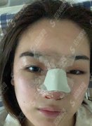 北京协和医院整形外科价目表2020，内含黄久佐医生肋软骨隆鼻案例果图