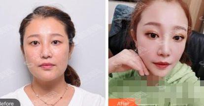 整形医生黄渭清眼部手术专业吗?北京协和医院/口碑如何/双眼皮案例