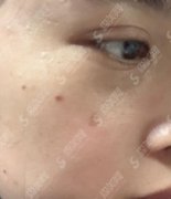 上海九院价目表2020,激光点痣多少钱?内含激光点痣案例果图