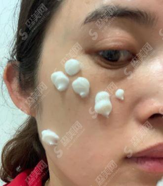 上海九院价目表2020，激光点痣多少钱？内含激光点痣案例果图