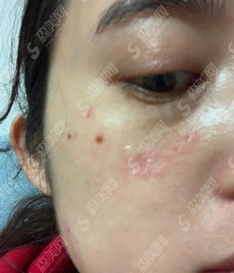 上海九院价目表2020，激光点痣多少钱？内含激光点痣案例果图