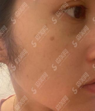 上海九院价目表2020，激光点痣多少钱？内含激光点痣案例果图