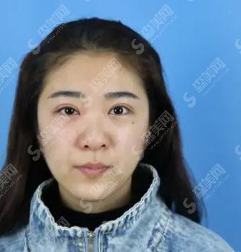 中国医科大学附属盛京医院医疗整形美容科价目表2021,内含王晓琴整形医生微针美肤案例果前后对比