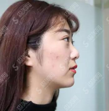 中国医科大学附属盛京医院医疗整形美容科价目表2021,内含王晓琴整形医生微针美肤案例果前后对比