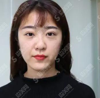 中国医科大学附属盛京医院医疗整形美容科价目表2021,内含王晓琴整形医生微针美肤案例果前后对比