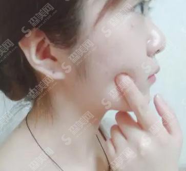 中国医科大学附属盛京医院医疗整形美容科价目表2021,内含王晓琴整形医生微针美肤案例果前后对比