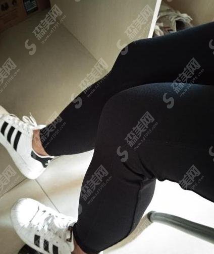 北京八大处整形医院价目表2021，内含焦虎医生大腿吸脂案例前后果图对比