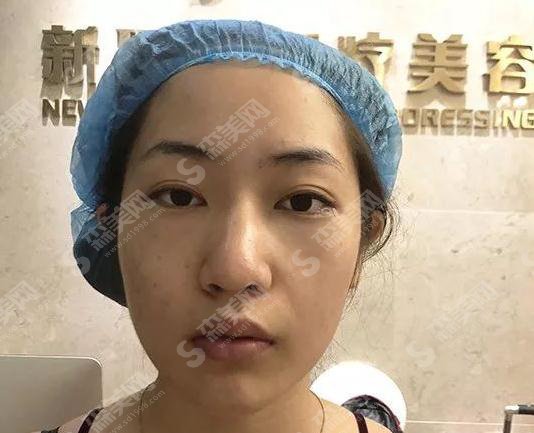 成都新颐美医疗美容整形门诊部价目表2021,内含激光去眼袋案例果图