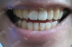 长沙优牙仕口腔医院价目表2021，冷光牙齿美白多少钱？内含冷光牙齿美白案例