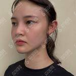 深圳整形医院价目表2021上门打水光补水怎么样？内附水光补水注射果对比图