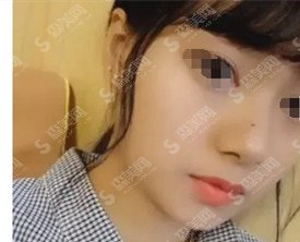 厦门中山医院整形价目表2020注射瘦脸的注射果？内含注射注射瘦脸的术后对比图