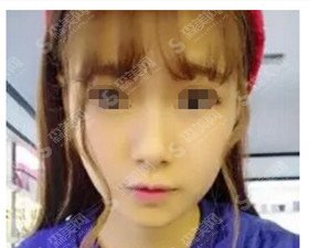 厦门中山医院整形价目表2020注射瘦脸的注射果？内含注射注射瘦脸的术后对比图