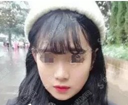 厦门中山医院整形价目表2020注射瘦脸的注射果？内含注射注射瘦脸的术后对比图