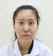 上海艺星医疗美容医院价目表2021，激光祛痘多少钱？内含激光祛痘案例