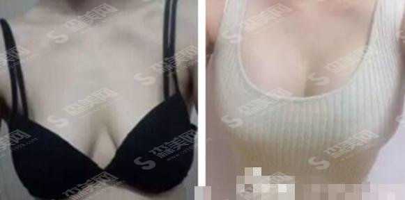 整形外科医生李伟乳房整形专业吗,重庆市第四人民医院整形科/口碑好吗/隆胸案例