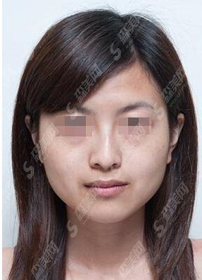 打注射瘦脸多少钱?打注射瘦脸的果好不好?附注射瘦脸介绍及打注射瘦脸案例分享