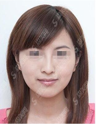 打注射瘦脸多少钱?打注射瘦脸的果好不好?附注射瘦脸介绍及打注射瘦脸案例分享