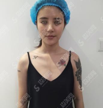 附北京协和整形医院的介绍,俞楠泽医生注射瘦脸真实案例分享