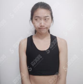 内含北京协和整形医院的介绍,王阳医生注射瘦脸真实案例分享