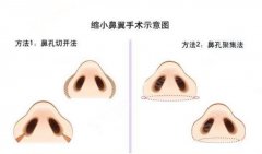 缩小鼻翼多少钱?附缩小鼻翼价格一栏及缩小鼻翼成功整形案例分享