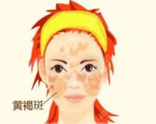激光祛除黄褐斑的价格？附祛除黄褐斑案例+前后果对比图