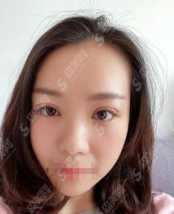 成都八大处双眼皮整形技术怎么样?内含田孝臣医生介绍双眼皮真人案例,前后对比果图