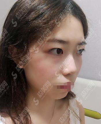 成都八大处双眼皮整形技术怎么样?内含田孝臣医生介绍双眼皮真人案例,前后对比果图