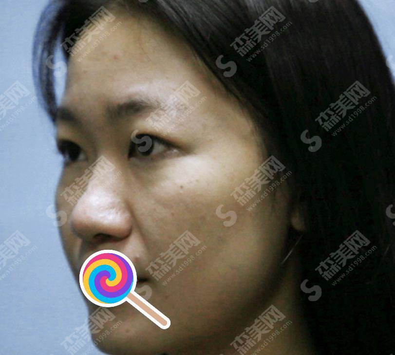 王珏整形医生专业吗？附王珏医生个人介绍及祛痘案例分享