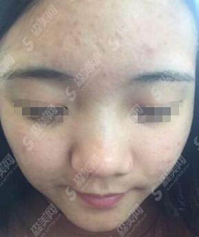 上海九院医院口碑好不好？内含2020祛斑项目较新价目表&范先群医生介绍&医生祛疤案例果对比