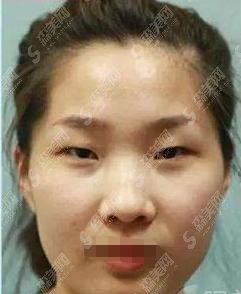 夏玲玲整形医生怎么样?夏玲玲做的双眼皮怎么样?附医院介绍及案例分享