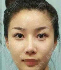 夏玲玲整形医生怎么样?夏玲玲做的双眼皮怎么样?附医院介绍及案例分享
