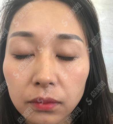 整形专家赵润蕾自体脂肪填充专业吗?北京大学第三医院整形科/口碑介绍/脂肪填充案例