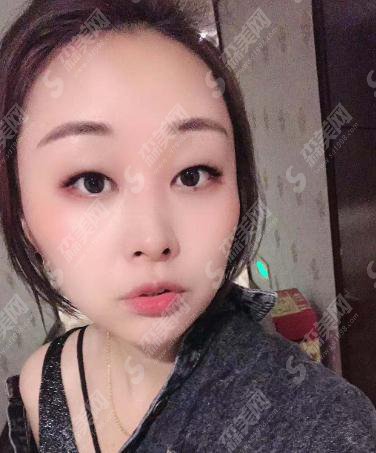 整形专家赵润蕾自体脂肪填充专业吗?北京大学第三医院整形科/口碑介绍/脂肪填充案例