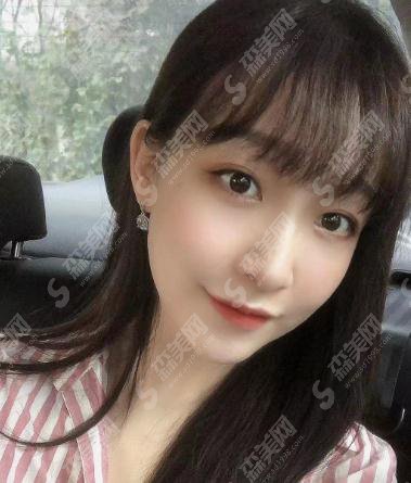 整形专家赵润蕾自体脂肪填充专业吗?北京大学第三医院整形科/口碑介绍/脂肪填充案例