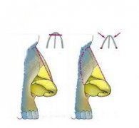 驼峰鼻矫正要多少钱?驼峰鼻矫正有什么优势?