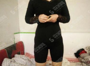 整形专家吴荣微吸脂做的如何?北京八大处/技术如何/吸脂案例