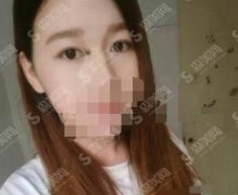 上海九院整形美容科价目表2021，激光去痣的价格，内含激光去痣的案例果图