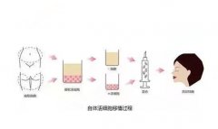 自体填充面颊多少钱？自体填充面颊持久保持吗？