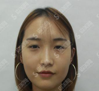 整形专家臧梦青眼部手术专业吗?北京八大处/口碑如何/案例展示