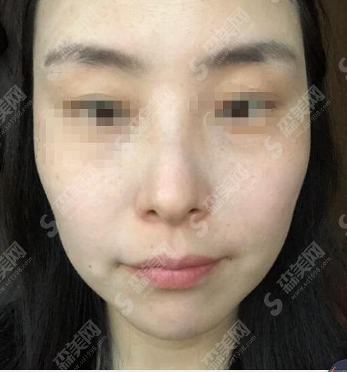 西京医美整形美容医院激光祛斑果好不好？内含彭湃医生介绍以及彭湃医生激光祛斑案例分享前后果对比