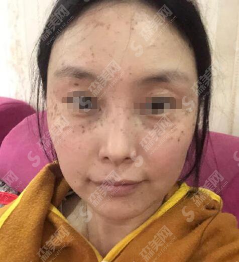 西京医美整形美容医院激光祛斑果好不好？内含彭湃医生介绍以及彭湃医生激光祛斑案例分享前后果对比