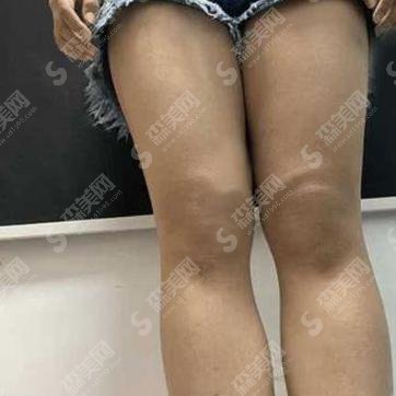 整形专家王春虎怎么样?王春虎做的吸脂果好不好?附医院介绍及案例分享