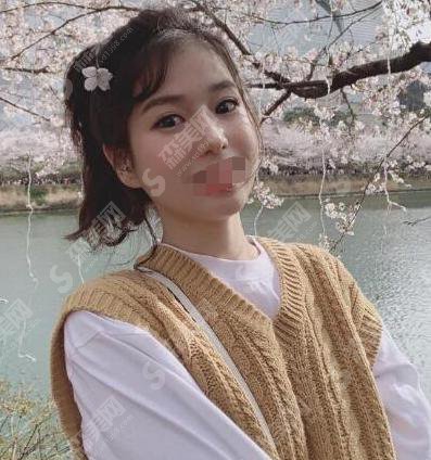 西京医院整形美容中心哪位医生做双眼皮好？内含西京医院介绍以及张曦医生介绍&张曦医生双眼皮整形手术前后对比