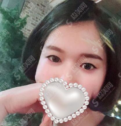 西京医院整形美容中心哪位医生做双眼皮好？内含西京医院介绍以及张曦医生介绍&张曦医生双眼皮整形手术前后对比