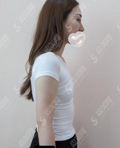 西安华京医院是正规医院吗?内含西安华京医院介绍以及马世理医生介绍&隆胸手术案例前后对比果图