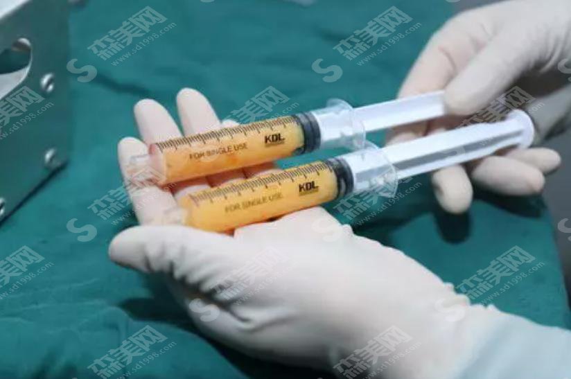 自体脂肪面部填充价格怎么样?自体脂肪面部填充价格一栏及自体脂肪面部填充成功案例分享